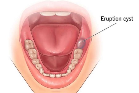 Eruption Cyst