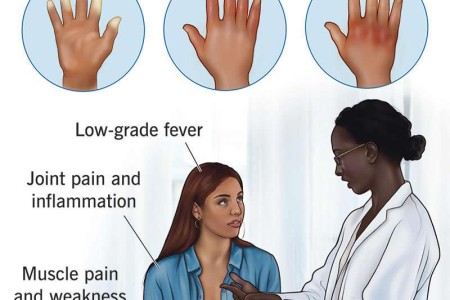 Mixed Connective Tissue Disease (MCTD)