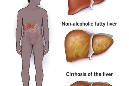 Steatotic (Fatty) Liver Disease