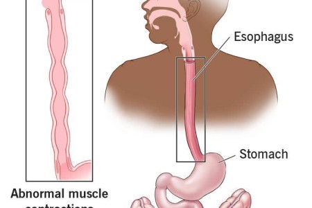Esophageal Spasms