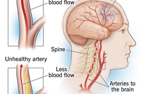 Transient Ischemic Attack (TIA)