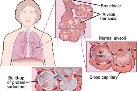 Pulmonary Alveolar Proteinosis