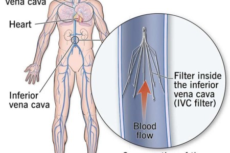 Vena Cava Filters