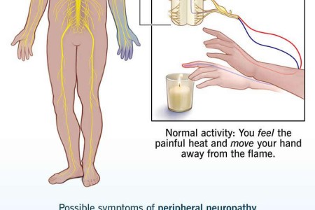 Peripheral Neuropathy
