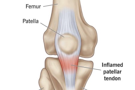Patellar Tendinitis (Jumper’s Knee)