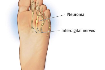 Morton's Neuroma