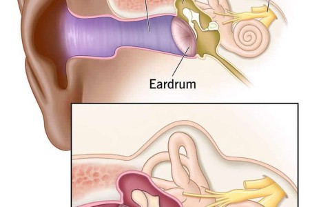 Ruptured Eardrum
