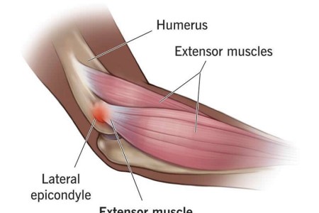 Tennis Elbow (Lateral Epicondylitis)