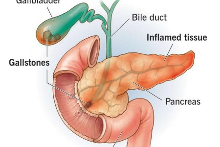 Pancreatitis