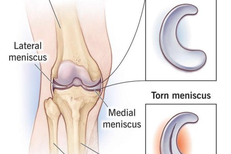 Torn Meniscus