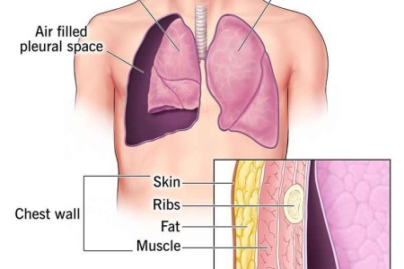 Pneumothorax (Collapsed Lung)