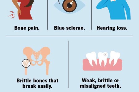 Osteogenesis Imperfecta (Brittle Bone Disease)
