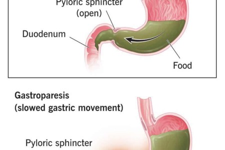 Gastroparesis