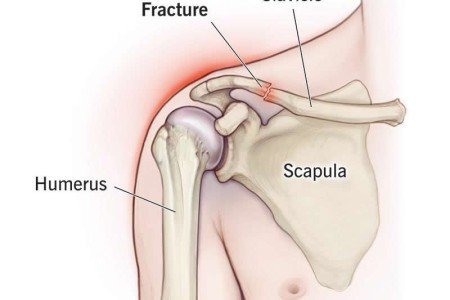 Shoulder Fracture