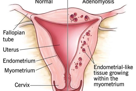 Adenomyosis