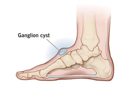 Ganglion Cyst