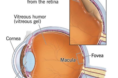 Posterior Vitreous Detachment