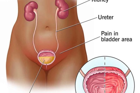Interstitial Cystitis/Bladder Pain Syndrome