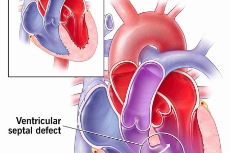 Ventricular Septal Defect (VSD)