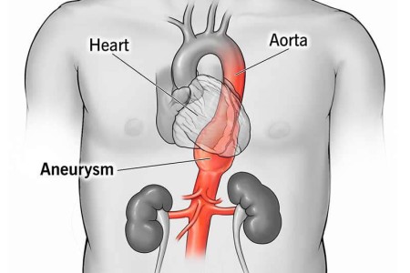 Thoracic Aortic Aneurysm