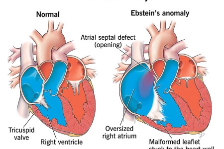Ebstein's Anomaly (Adults)