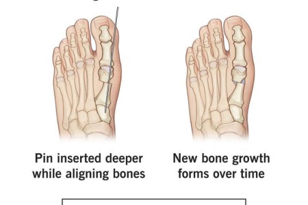 Bunion Surgery (Bunionectomy)