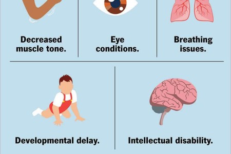 Joubert Syndrome