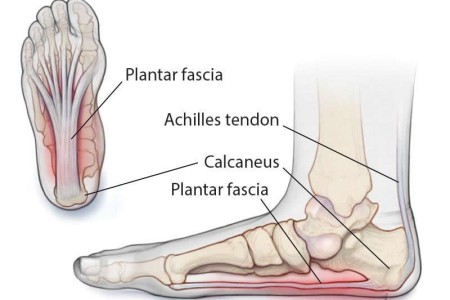 Plantar Fasciitis