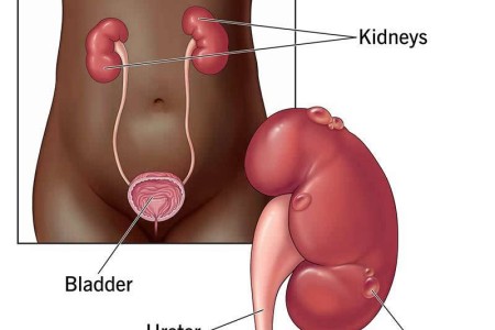 Kidney Cysts