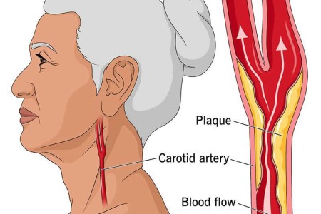 Carotid Artery Disease (Carotid Artery Stenosis)