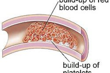 Blood Clotting Disorders (Hypercoagulable States)