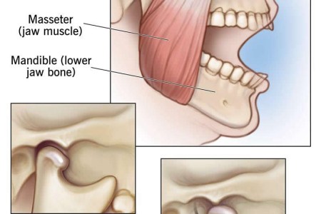 Temporomandibular Joint (TMJ) Disorders