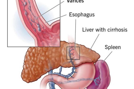 Esophageal Varices