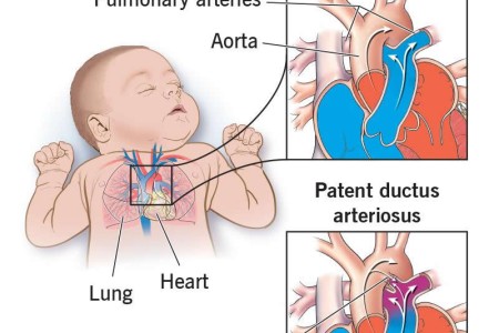 Patent Ductus Arteriosus (PDA)