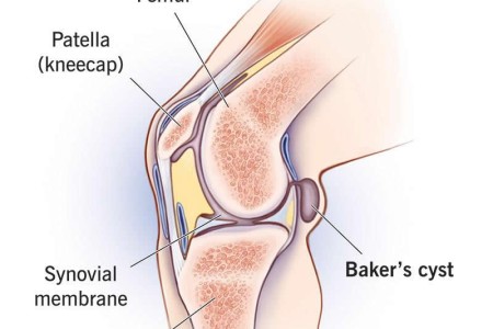Baker Cyst (Popliteal Cyst)