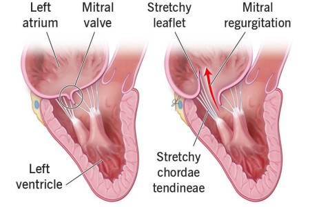 Mitral Valve Prolapse