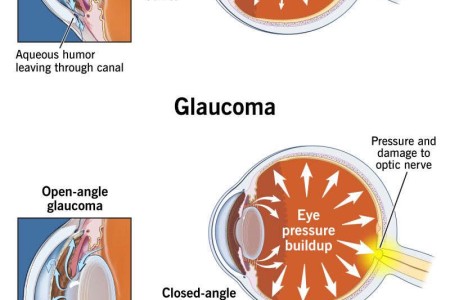 Glaucoma
