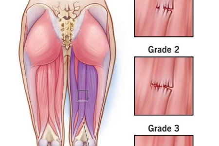Hamstring Injury