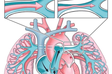 Pulmonary Hypertension (PH)
