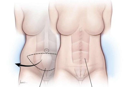 Abdominoplasty (Tummy Tuck)