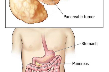Pancreatic Cancer