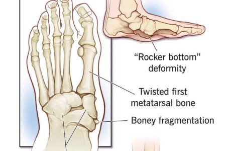 Charcot Foot