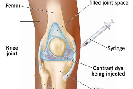 Arthrogram