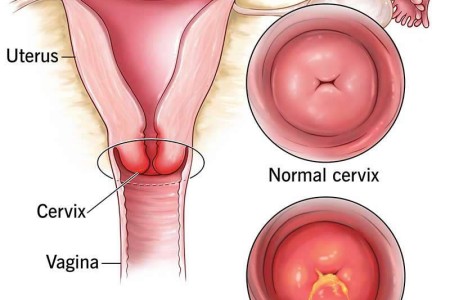 Cervicitis