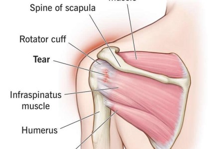 Swimmer's Shoulder