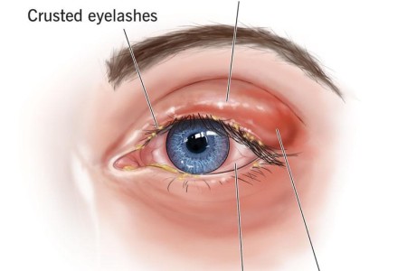 Blepharitis