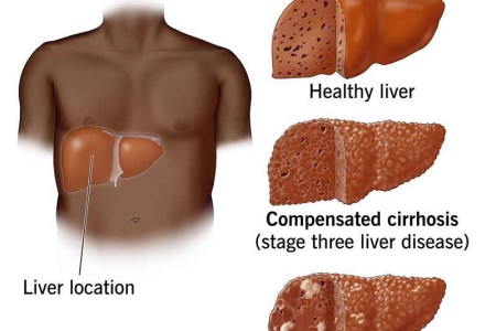 Cirrhosis of the Liver