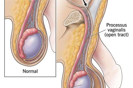 Hydrocele