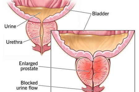 Benign Prostatic Hyperplasia