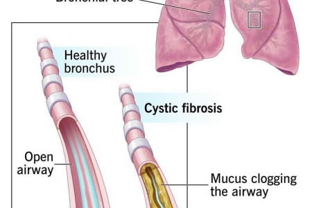 Cystic Fibrosis
